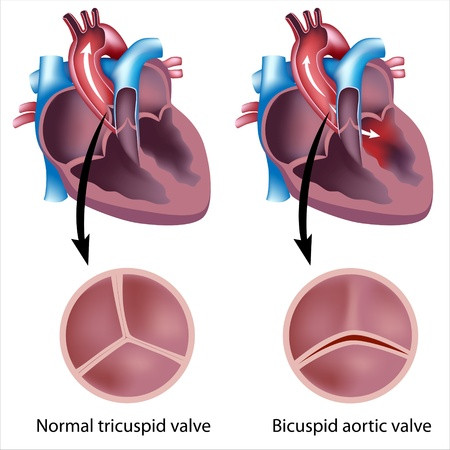 Valvula aortica bicúspide-IMP